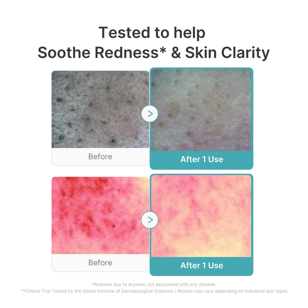 Azelaic Acid Capsule Foam Cleanser - Soft Touch Pore Care